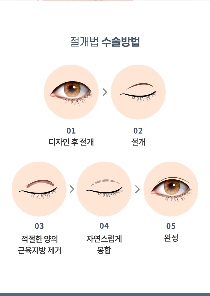 절개법