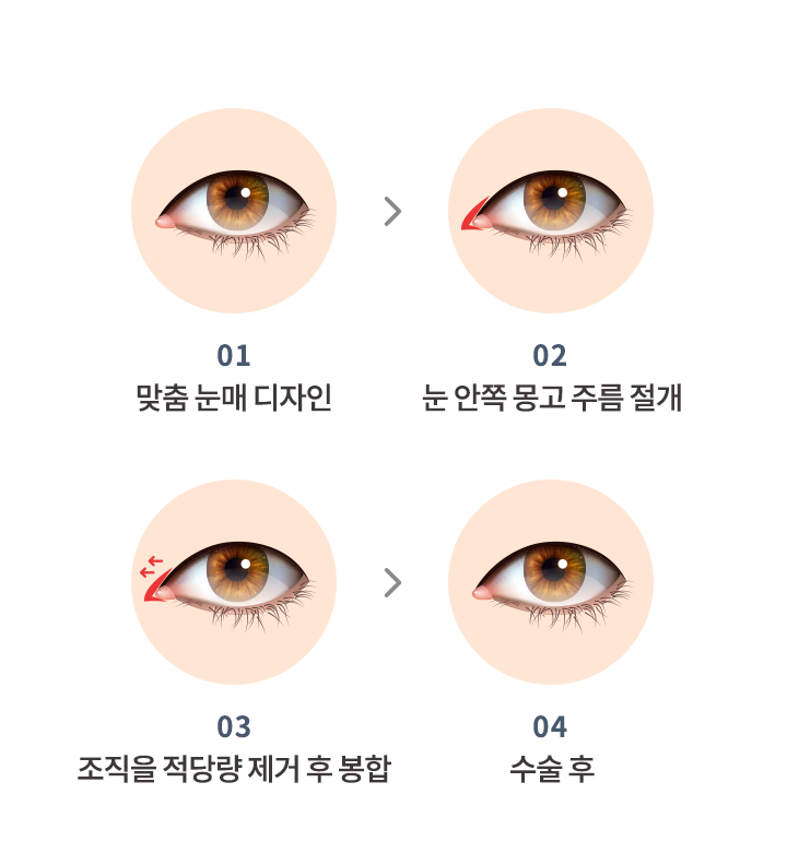 앞트임 수술방법