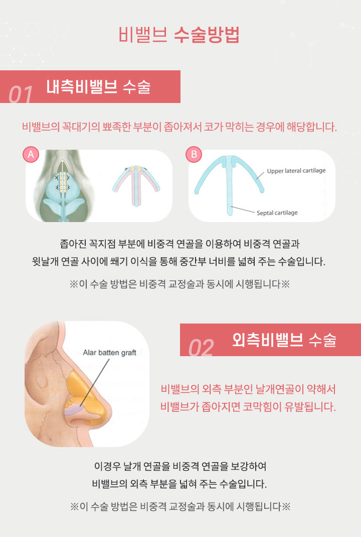 비밸브 수술방법