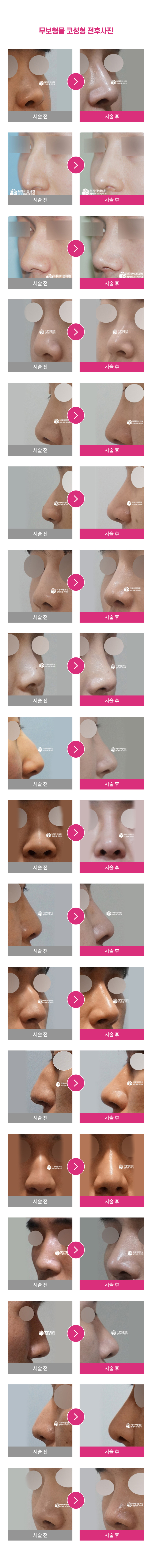 에스탑 무보형물코성형 전후사진