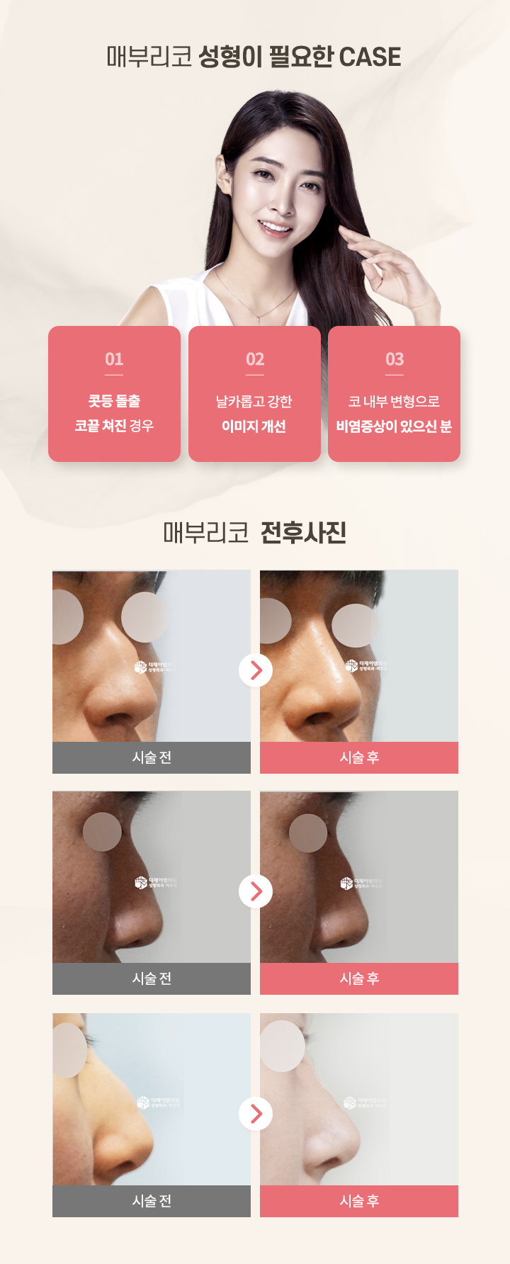 매부리코