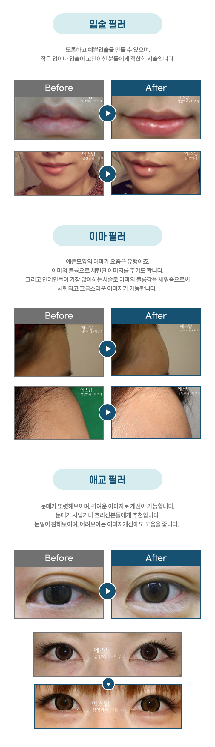 에스탑 입술필러, 이마필러, 애교필러
